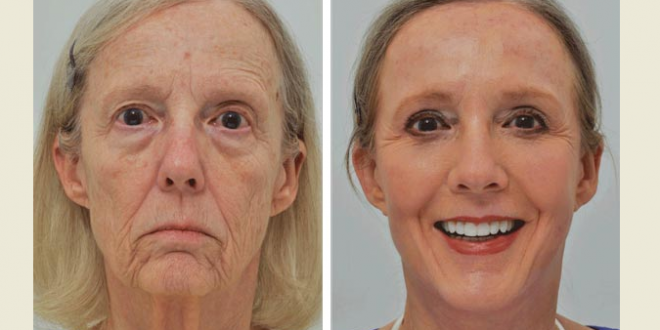 موثرترین روش ها برای درمان افتادگی پوست صورت